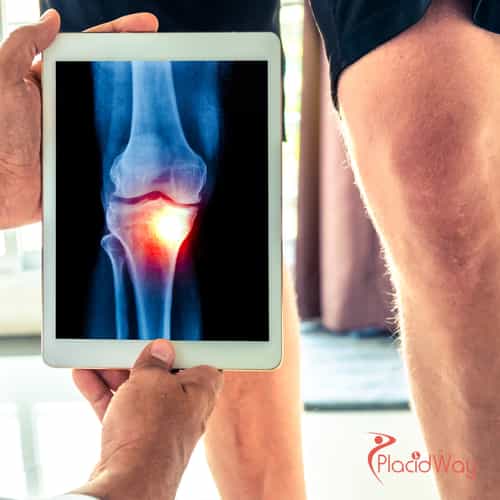 Knee Replacement Surgery in Turkey: Restore Mobility with High-Quality Treatment for Australian Tourists